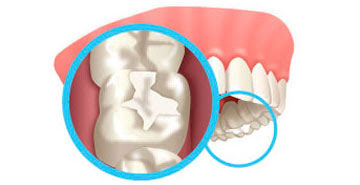 Just Smile  Dental Center | Conducto Radicular, 3D CT Scan and ClearCorrect reg 