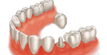 Just Smile  Dental Center | Dentaduras, Carrilas and 3D CT Scan